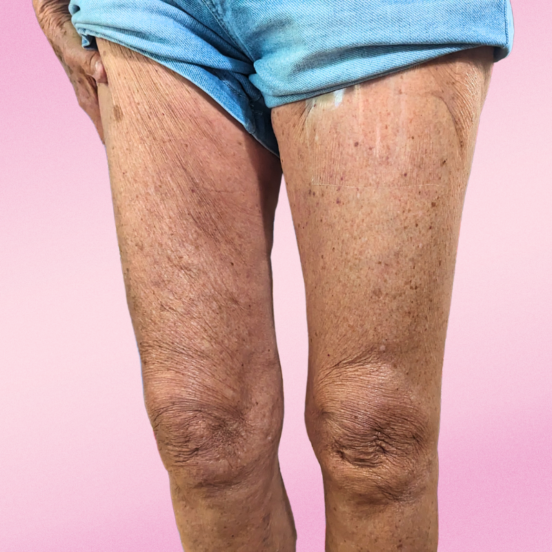 the instalift - leg lifter